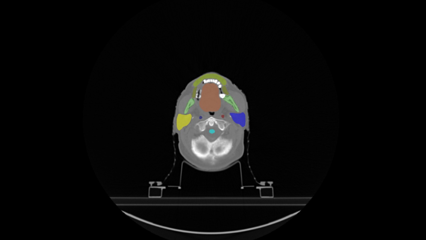 ImagiXAI automatic segmentation of skull-base organs at risk on a head CT scan