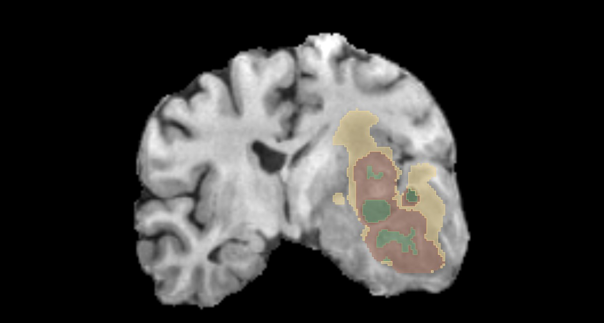 ImagiXAI automatic segmentation of skull-base organs at risk on a head CT scan
